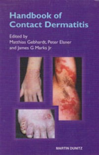 Handbook of Contact Dermatitis